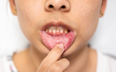 ¿Por qué me sangran las encías? Señal de alerta para tu salud bucodental