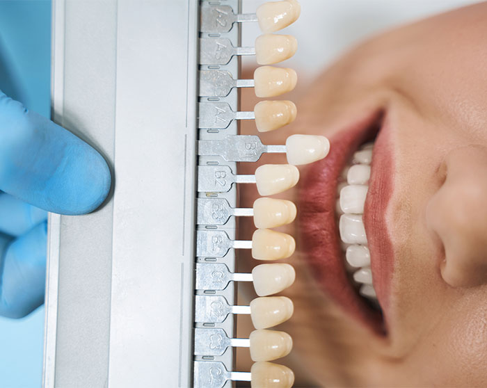 Baragado-dental-carillas