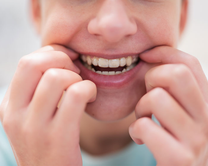 Bragado-dental-odontopediatria-invisalign first