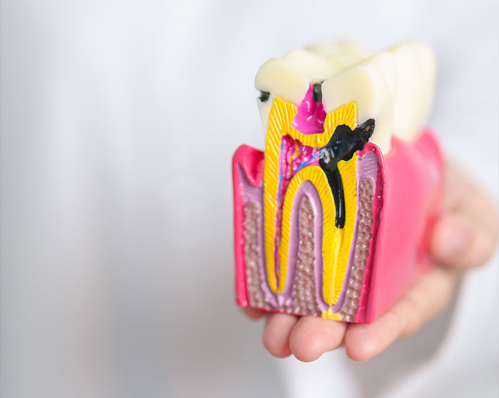 Bragado-endodoncia-caries