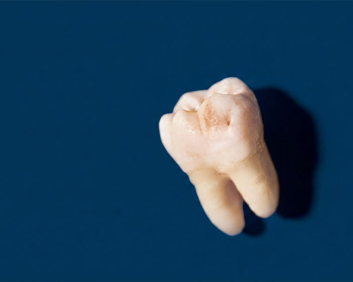 Bragado-endodoncia-fractura