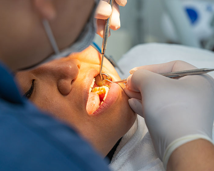 Bragado-periodoncia-curetaje